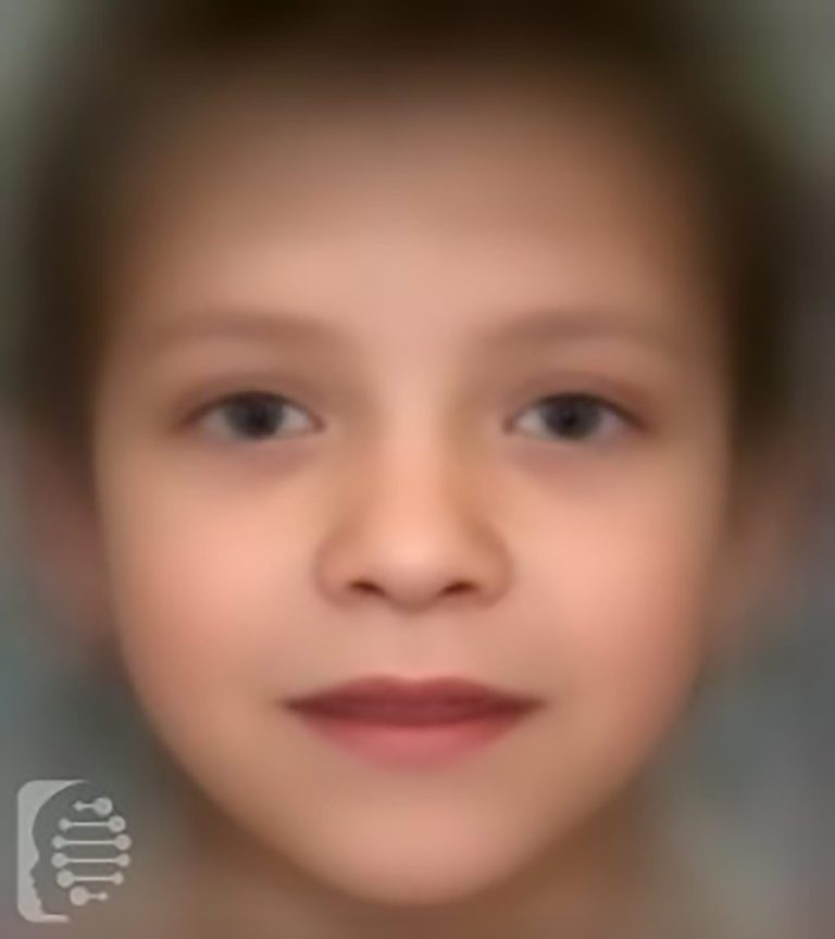 Noonan Syndrome with Multiple Lentigines OMIM PS151100 FDNA