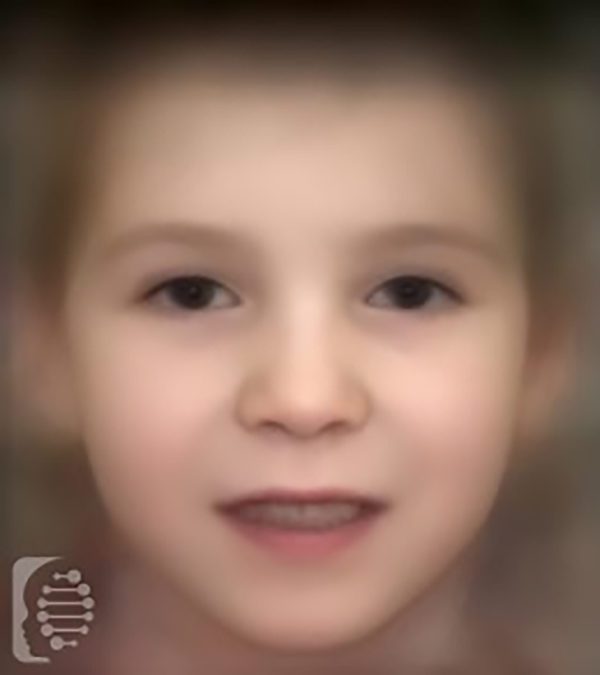 SATB2 Syndrome (Glass Syndrome) OMIM 612313 FDNA